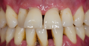 gum disease progression, tooth loss prevention, silent gum disease, periodontal disease symptoms, gum infection risks, tooth loss causes, early gum disease signs, periodontal health tips, gum disease treatment options, prevent tooth decay