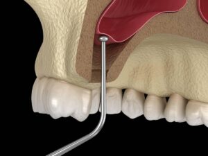 bone grafting, sinus lift, dental bone augmentation, sinus lift procedure, bone graft surgery, dental implant preparation, implant sinus lift, jawbone regeneration, sinus lift risks, bone graft recovery