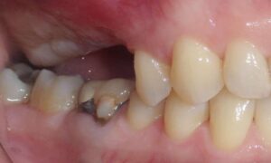 missing back teeth, tooth loss impacts bite, dental health after missing teeth, jaw alignment issues, chewing problems from missing teeth, tooth loss and jaw health, dental replacement options, dental implant benefits, effects of missing molars, bite correction after tooth loss